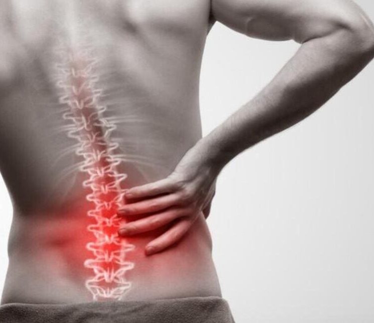 pinzamiento lumbar &#8211; Que es, sintomas, tratamiento