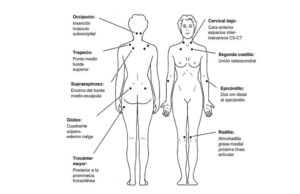 puntos gatillo fibromialgia ubicación