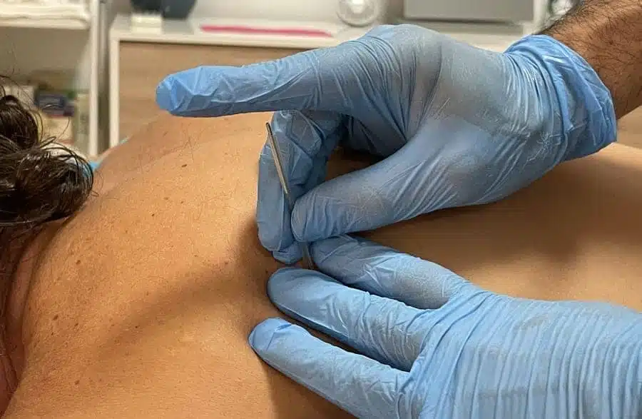 Acupuntura y Punción Seca para Aliviar el Dolor Muscular