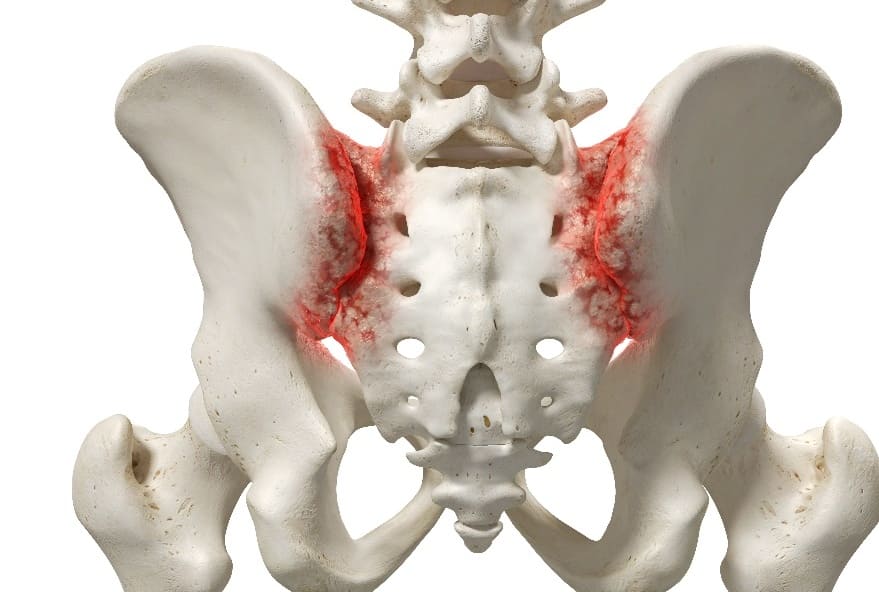 Sacroileitis