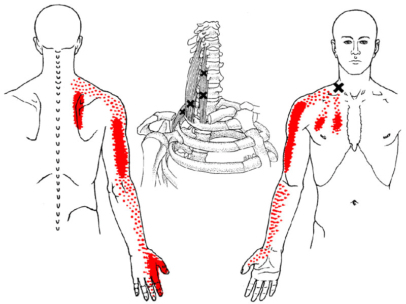 Puntos Gatillo – Que son y tratamiento con fisioterapia