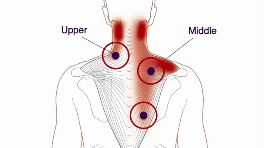 Puntos gatillo del trapecio - Qué es, síntomas, tratamientos y dolor referido